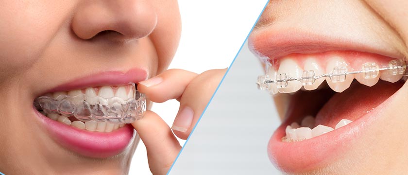 Clear Braces vs Invisalign: Wich is the better option in 2024? - Rendon  Orthodontics