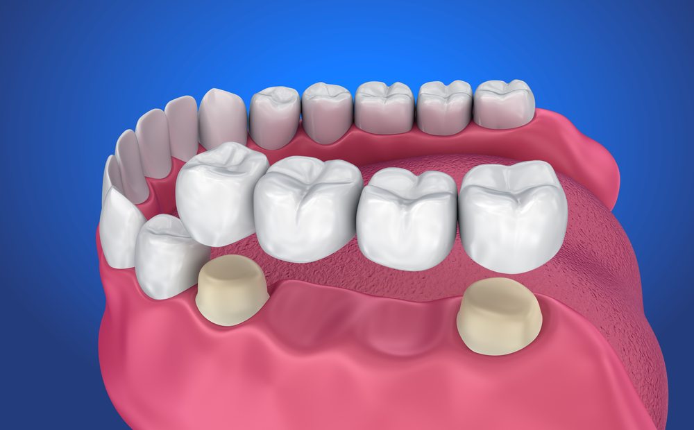Dental-Bridge-1