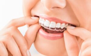 Clear Aligners' Clear Advantages Over Clear Braces