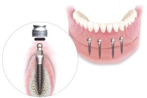 Mini-Dental-Implant